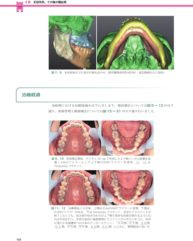 Amazon.co.jp: 実践的リンガルブラケット矯正 : 松野 功: Japanese Books
