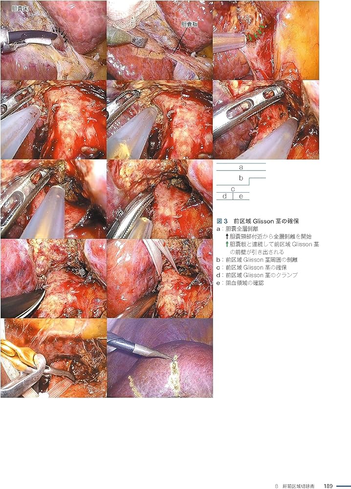 坂の上のラパ肝・胆・膵[Web動画付]: 腹腔鏡下手術が拓く肝胆膵外科の