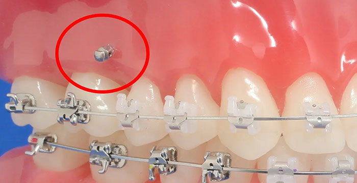 歯科矯正用アンカースクリューを用いた治療｜見えにくい装置で矯正治療