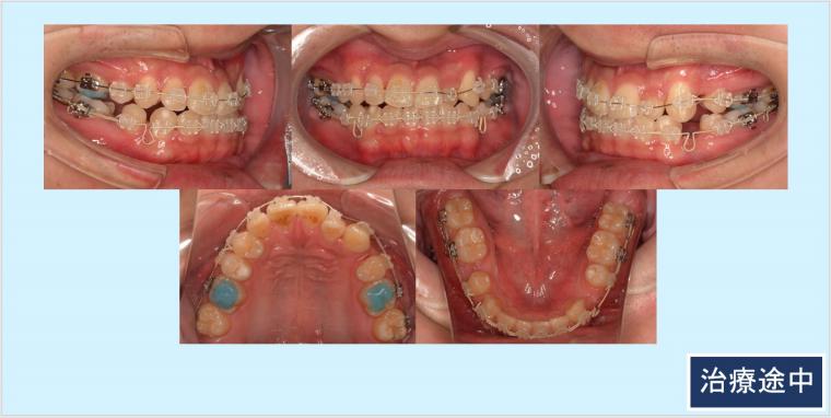 No.33 外科矯正をせずに矯正治療のみで反対咬合を改善した症例 | 見え