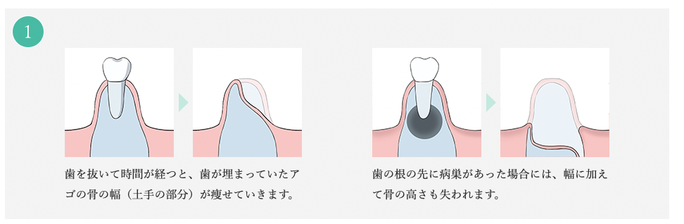 GBR 法／骨誘導再生法 について(Guided Bone Regeneration) - 【神奈川