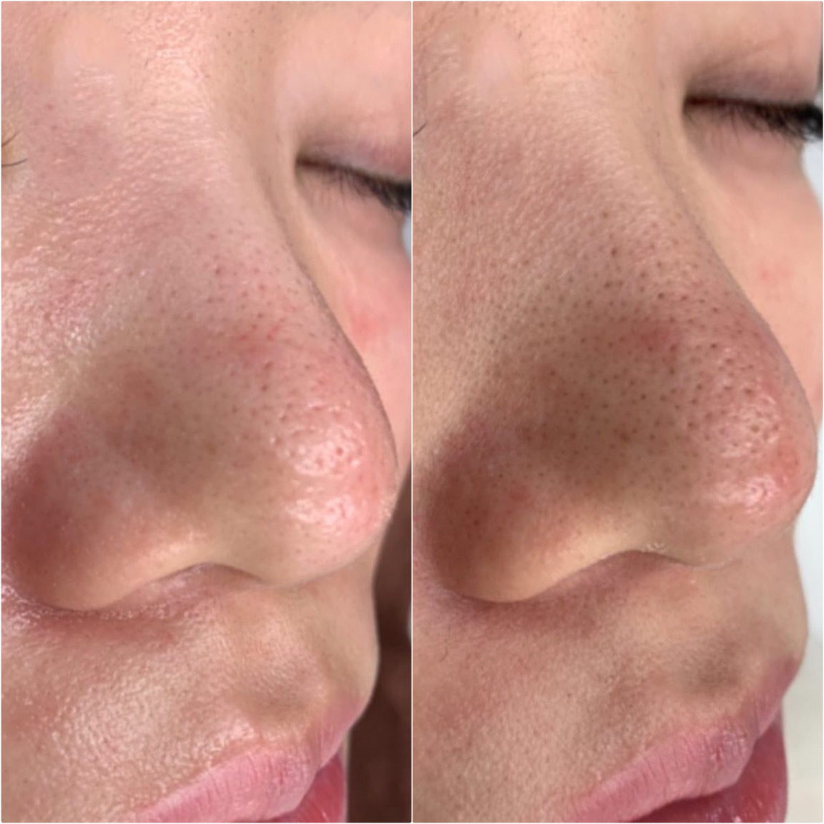 ほぼ新品！ハイドラフェイシャル ハイドラフェイシャル｜KM新宿クリニック