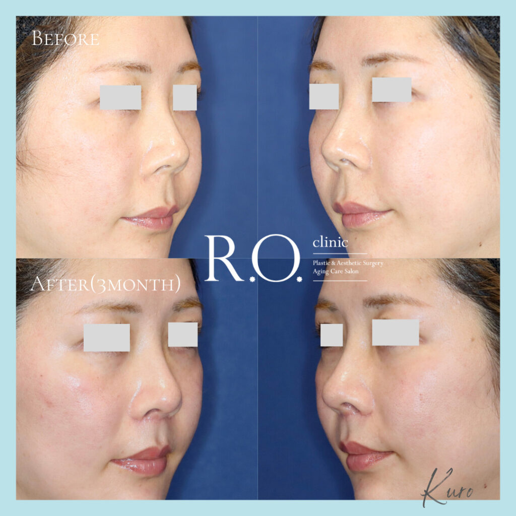 顔/ 鼻（Rhinoplasty） | R.O.clinic | 表参道駅徒歩3分