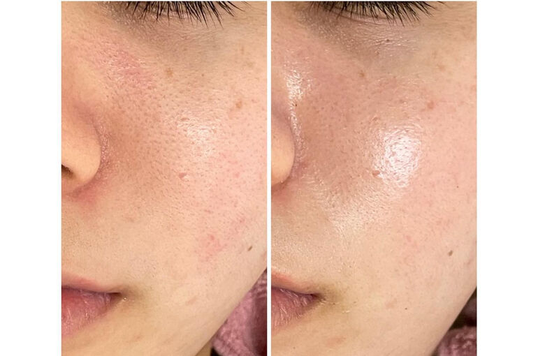 剥離しないハーブピーリング「REVI陶肌トリートメント」で肌質改善