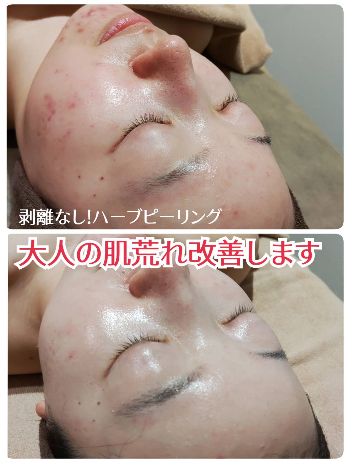 剥離なし☆即日美肌！肌質改善ハーブピーリング - Salon de HINOKI