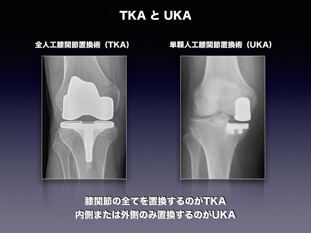 人工膝関節置換術とは？ │ 整形外科のいろいろ