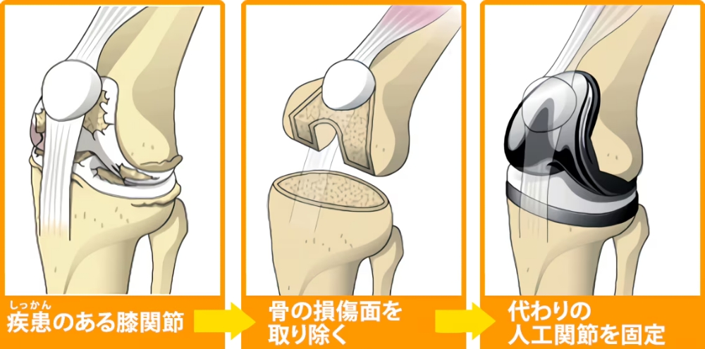 人工膝関節全置換術とは・・・どんな手術？ | 札幌いがらし人工関節