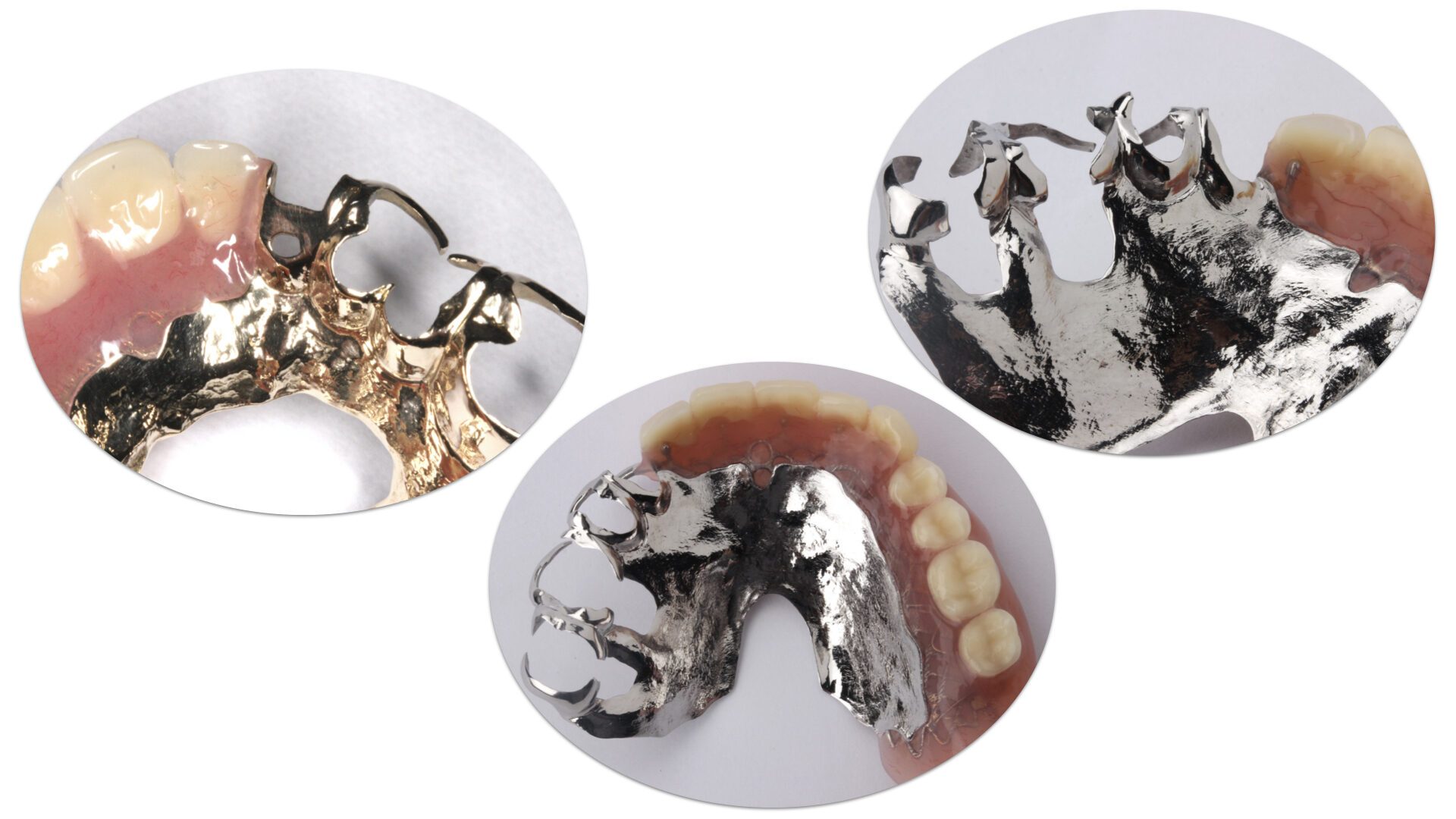 金属床 – 歯科技工所｜株式会社シンワ歯研