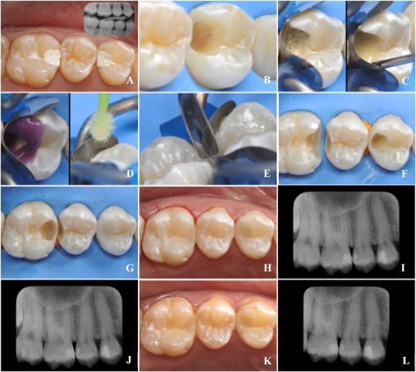 Vital Pulp Therapy: A Three-Year Clinical Case Series on