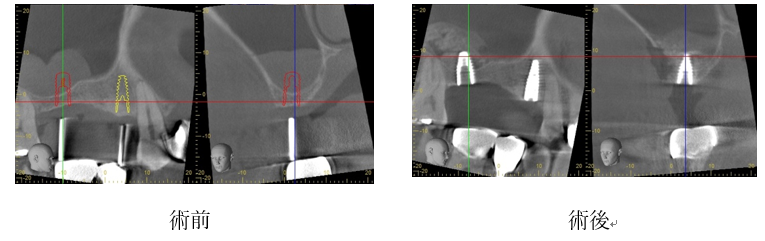 Perfect Sinus Lift - 上顎洞底挙上のすべて Perfect Sinus Lift