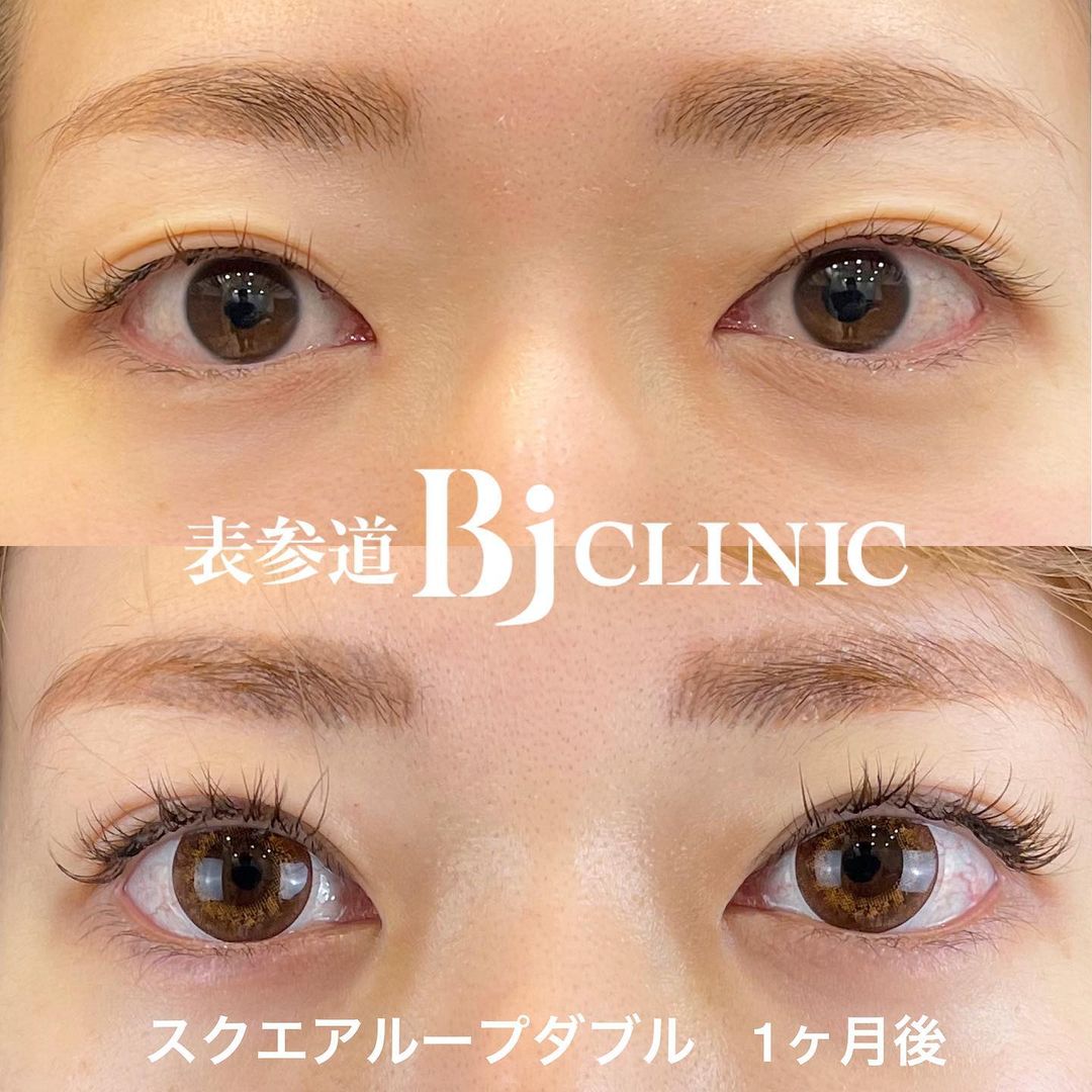 涙袋形成なら表参道Bjクリニック美容外科・美容皮膚科