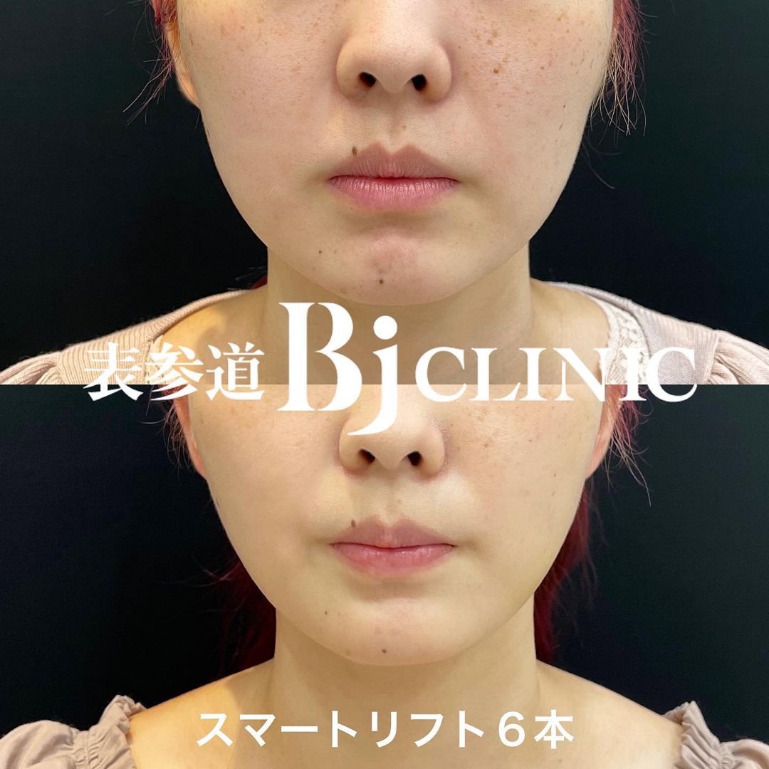 Bjリフト(PCL)なら表参道Bjクリニック美容外科・美容皮膚科