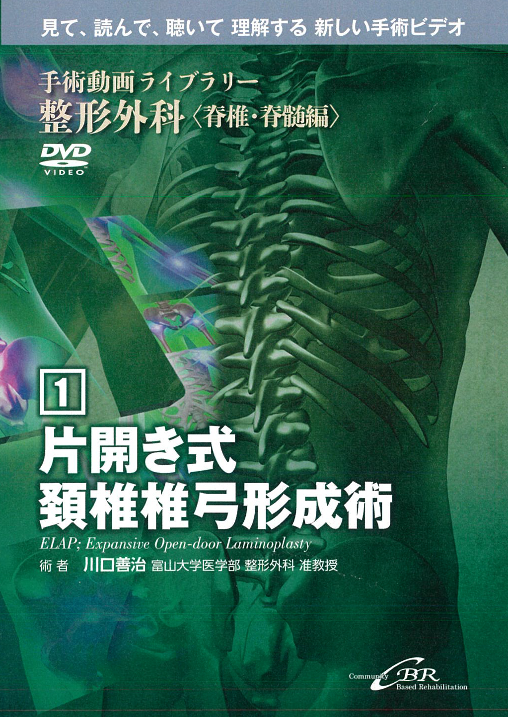 片開き式頚椎椎弓形成術 ELAP; Expansive Open-door Laminoplasty