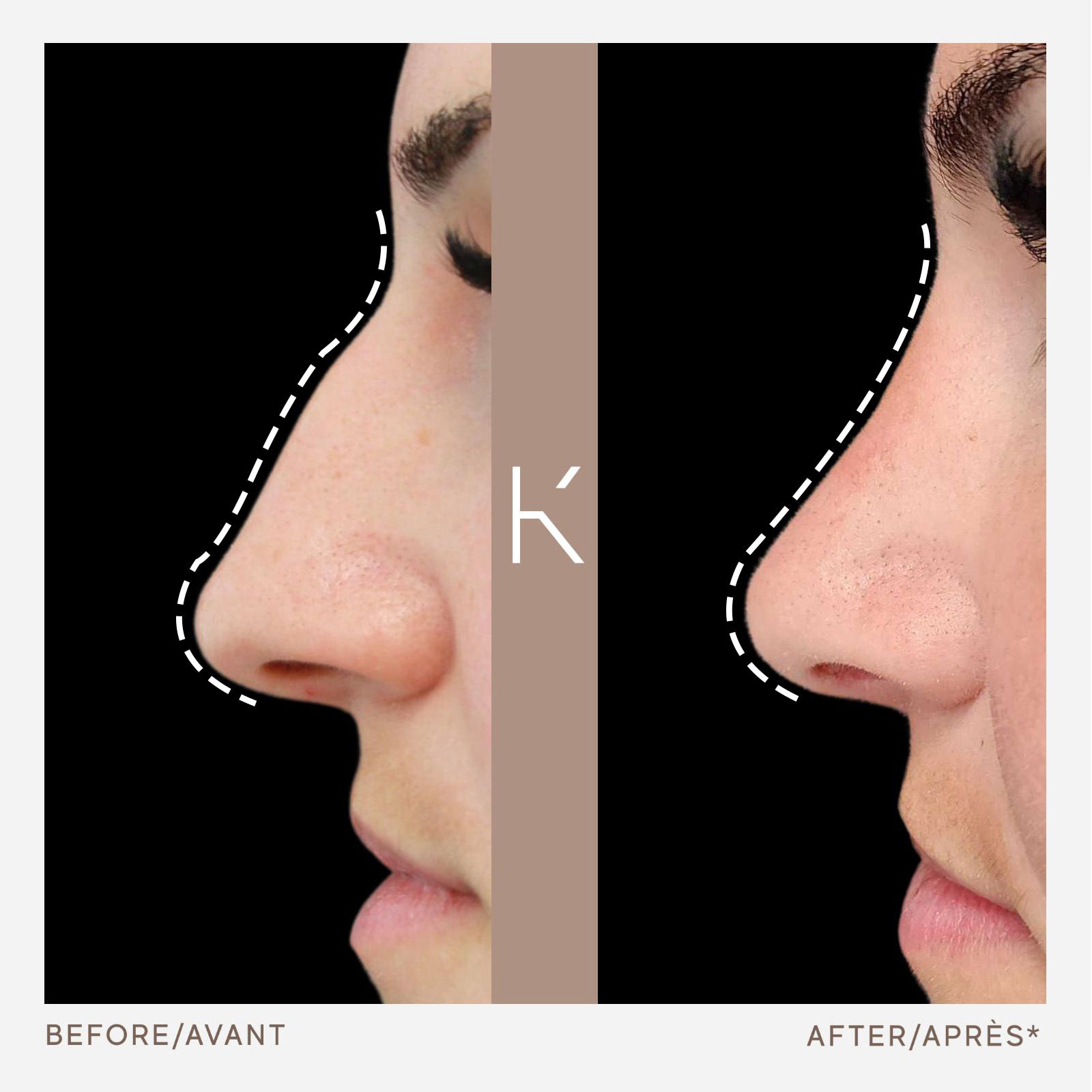 Nose Surgery Montreal Rhinoplasty | Plastic Surgery Westmount