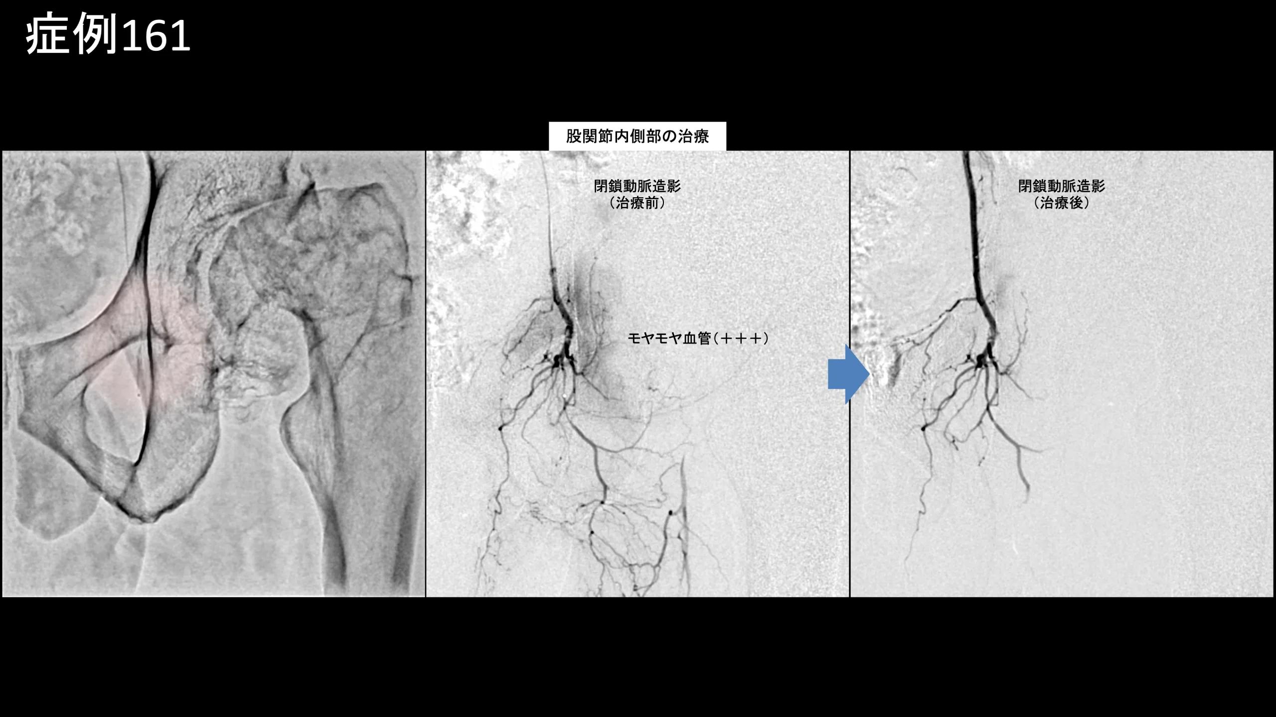 人特発性大腿骨頭壊死症に対するモヤモヤ血管治療