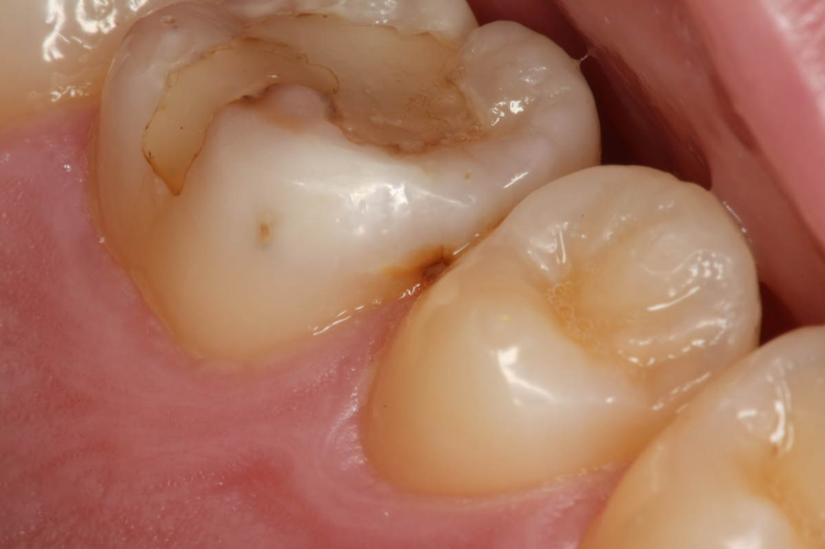 cavity_img_00c | Shimizu Dental Clinic